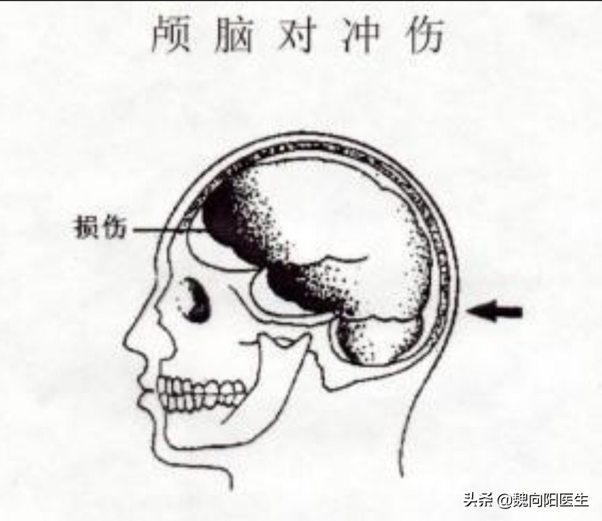 后脑勺着地有什么后果,后脑勺着地死亡率高吗