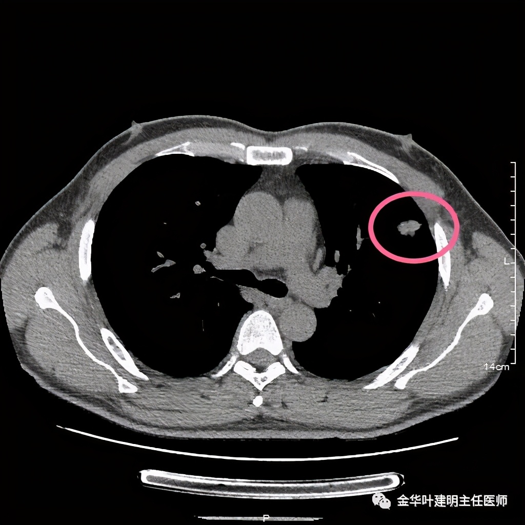 叶建明谈肺结节:一招分辨隐球菌性肉芽肿与肺癌