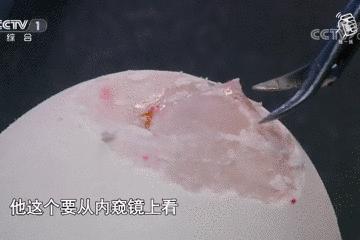 鸡蛋皮缝合手术,缝合鸡蛋膜视频教程