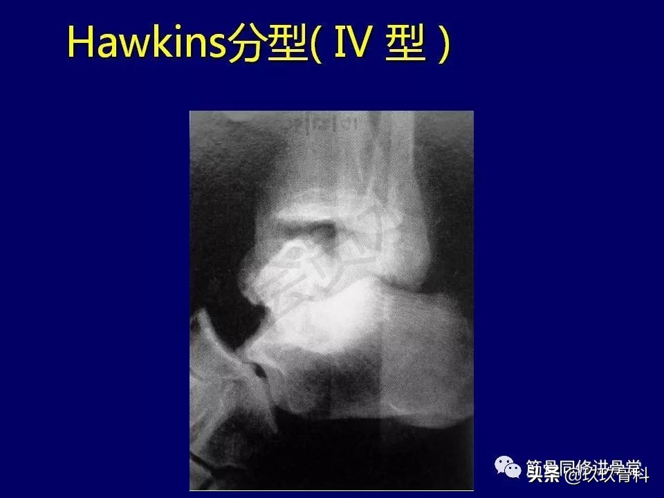 距骨骨折后遗症,距骨骨折怎么办