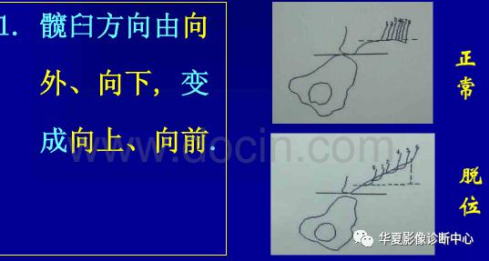 先天性髋关节脱位,先天性髋关节脱位属不属于残疾人