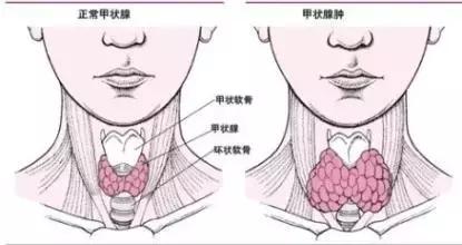 甲亢药物治疗期间甲减停药,甲亢吃药期间应注意什么