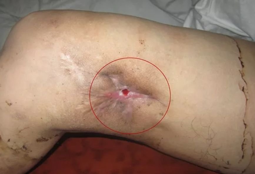 骨髓炎为什么越来越难治疗,如何才算治好慢性骨髓炎