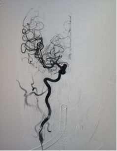 Tubridge®治疗多发性动脉瘤