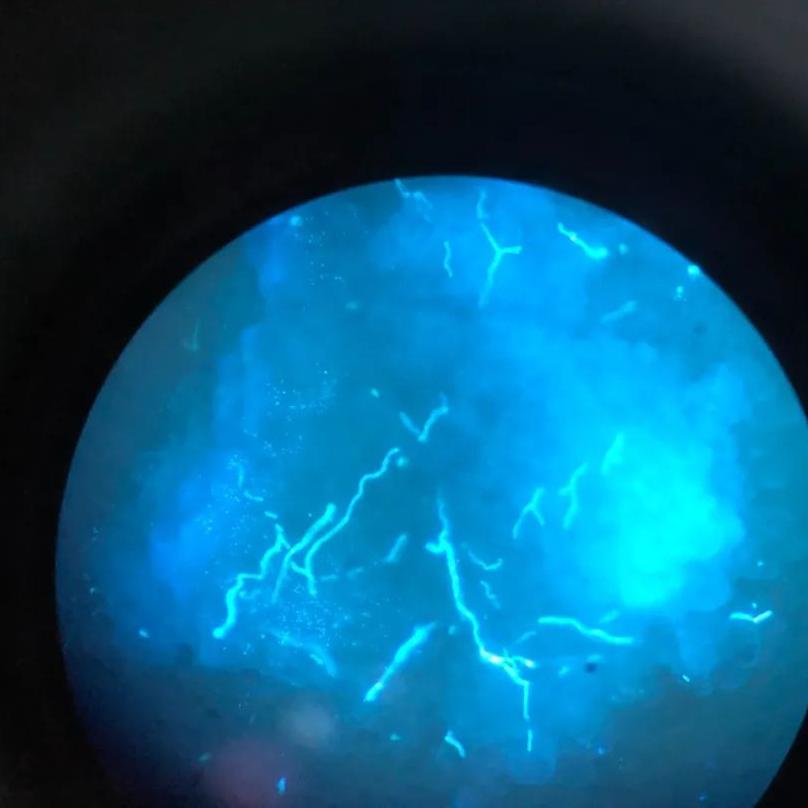 脚上真菌感染脱皮干裂怎么办,脚上脱皮又痒是真菌感染