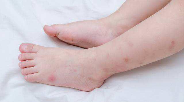 防蚊虫的小妙招家里有宝宝,帮助宝宝舒缓被蚊虫叮咬后的不适