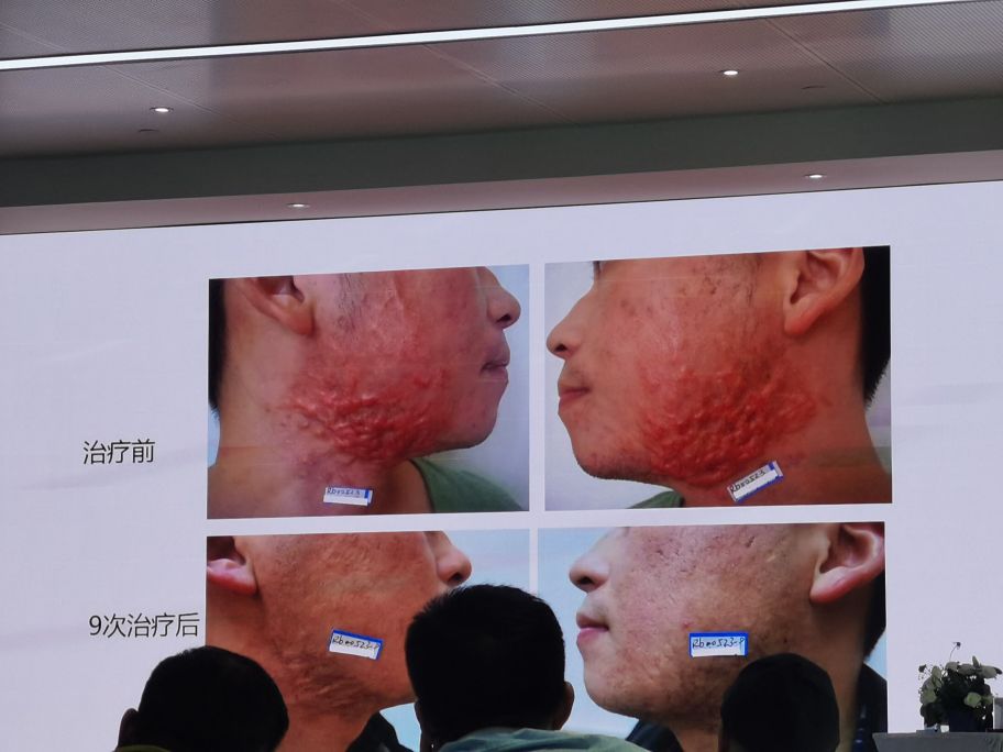 脉冲染料激光治玫瑰痤疮怎么收费,脉冲染料激光治疗瘢痕疙瘩