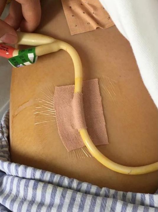 腹腔积液严重吗怎么治疗,癌症引起恶性胸腹腔积液