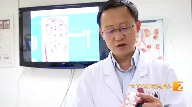 双肾多发结石取出2000多颗,史上最大手术取出肾结石