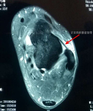 踝关节扭伤打绷带的图片,踝关节扭伤消肿治疗方法