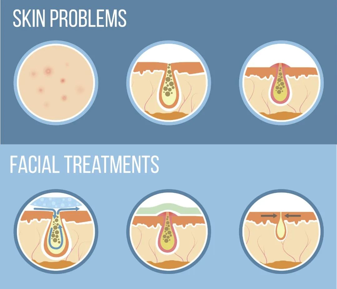 收缩毛孔轻松说拜拜,收缩毛孔不反弹最好的办法是什么