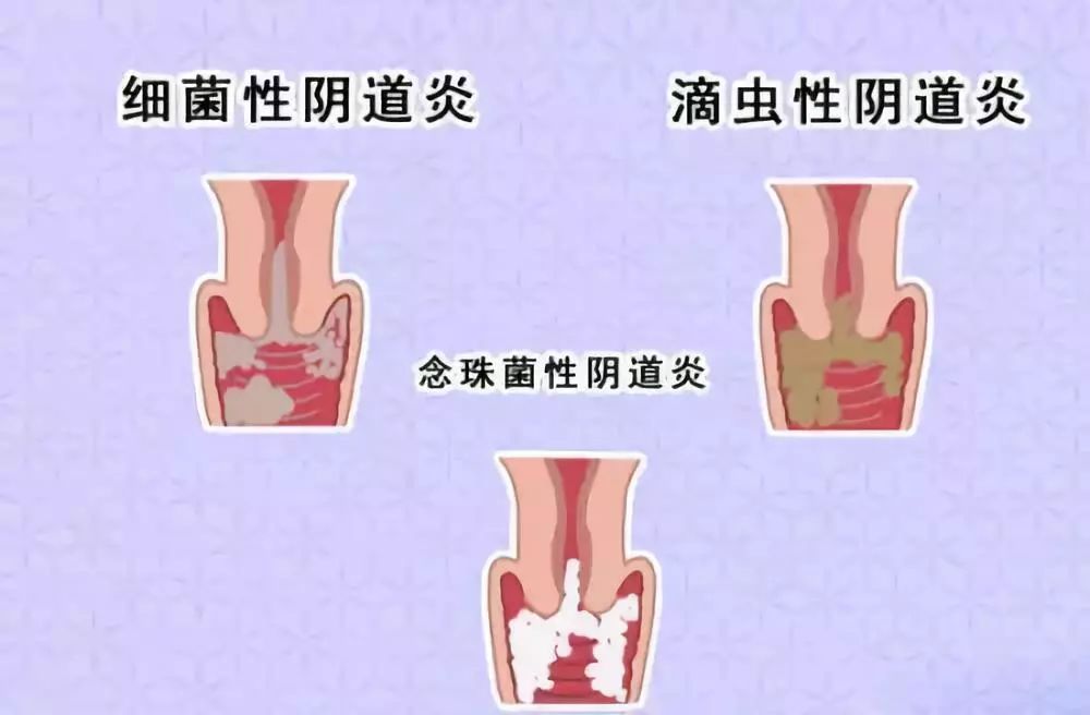 自从有了*生活性**,多数女性都得了这种病!这细节每位女性都要注意