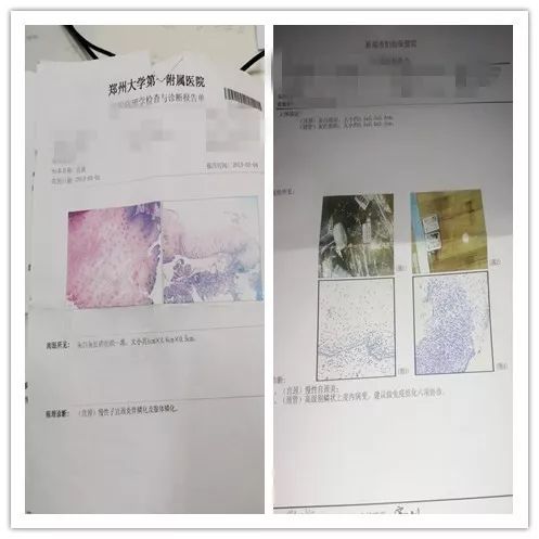 预防宫颈癌先从HPV下手