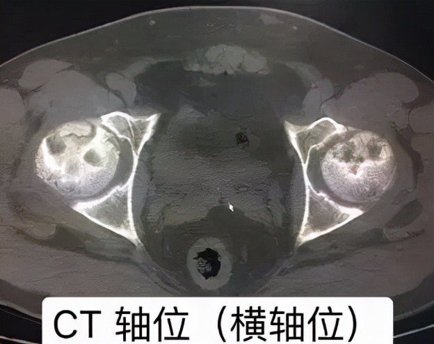 股骨头坏死和腰间盘突出症状区别,椎间盘突出和股骨头坏死症状区别