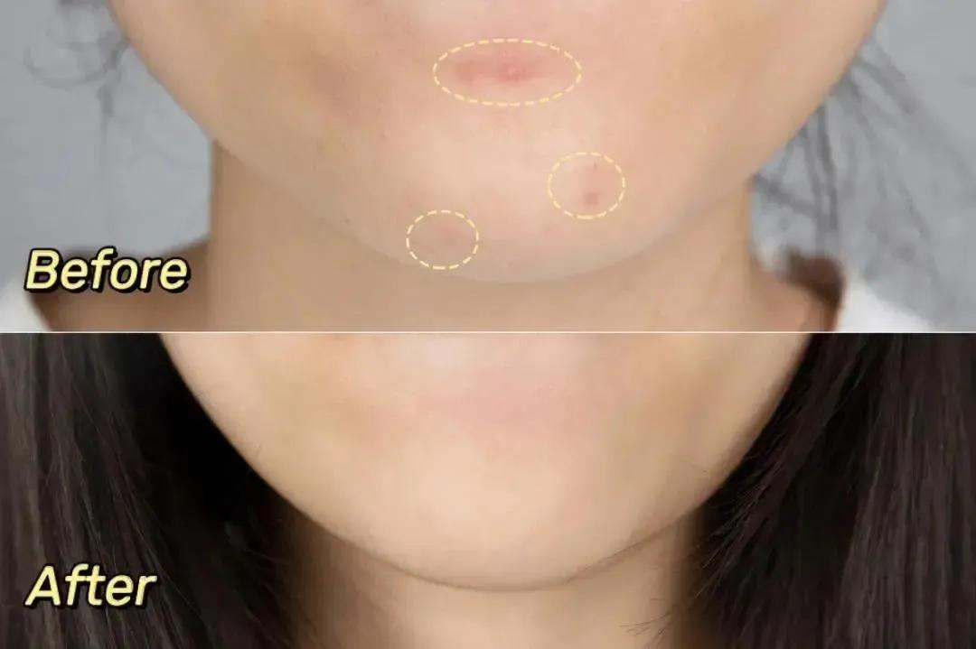 果酸换肤术后护理,果酸换肤没有注意防晒会怎么样