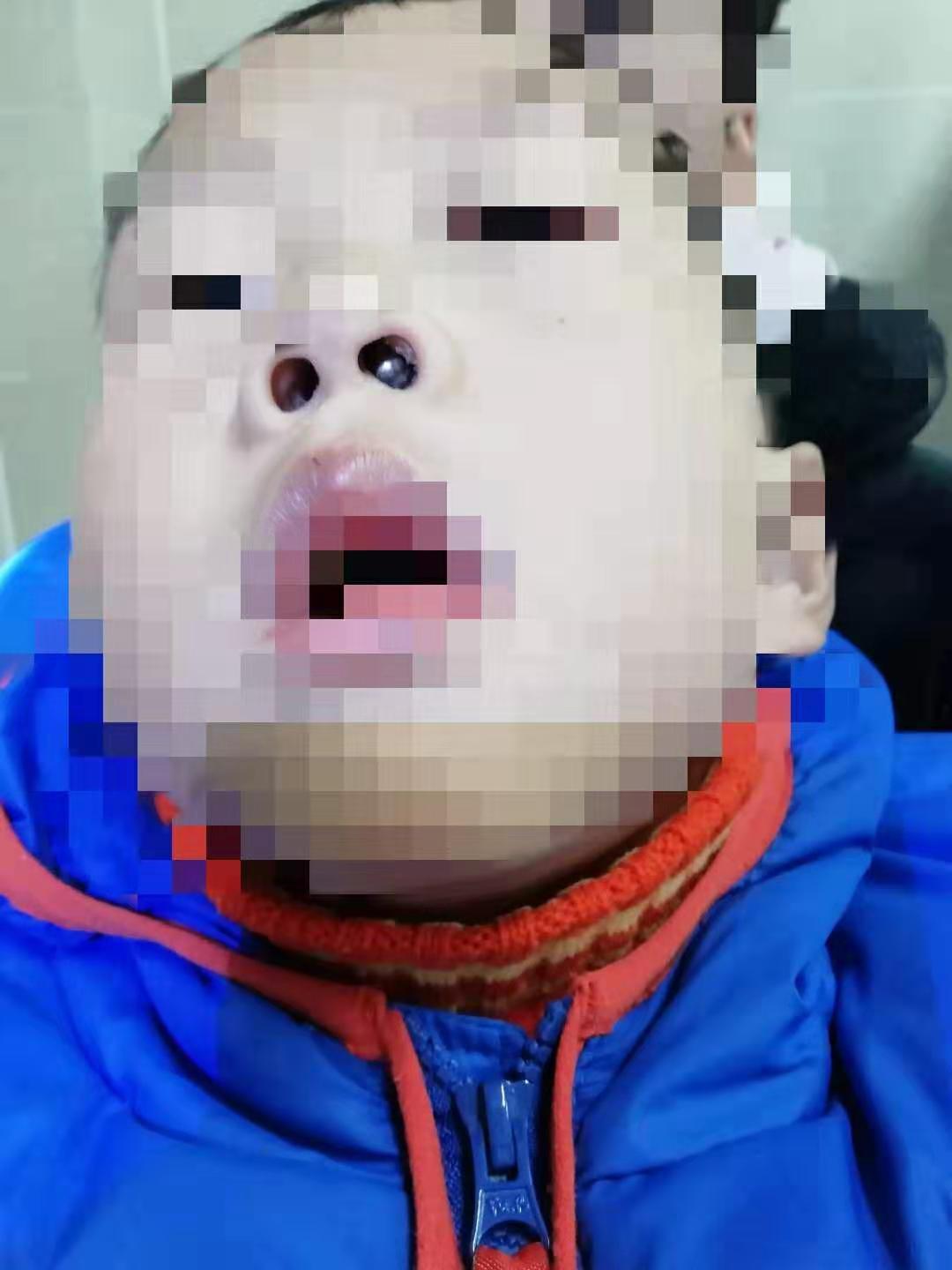 家长注意！徐州多名孩子鼻孔里出现了*珠钢**、西瓜、橡皮泥……