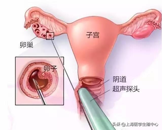 试管知识|穿刺取卵疼不疼，对身体有什么影响？