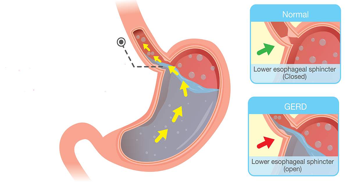 嗓子反酸吃什么药,嗓子疼胃反酸是怎么回事