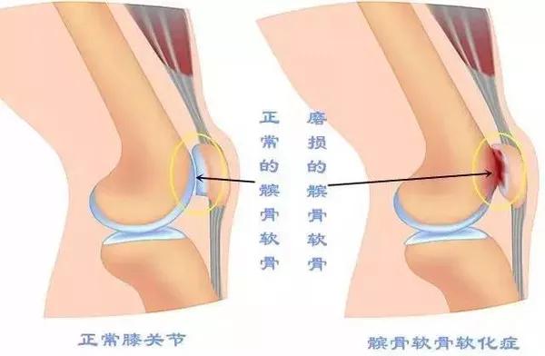 怎么查体判断髌骨软化,髌骨软化是发炎还是磨损