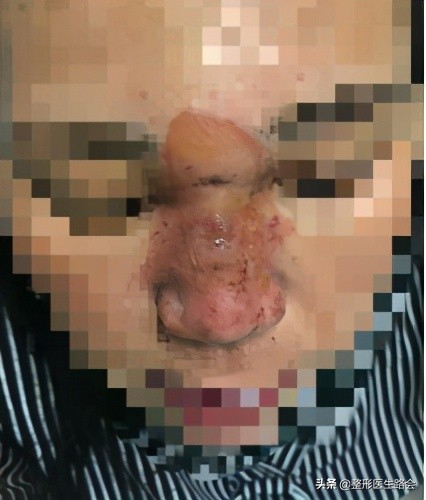 拉皮去法令纹怎么去除最安全永久,做拉皮能去除法令纹能坚持多久