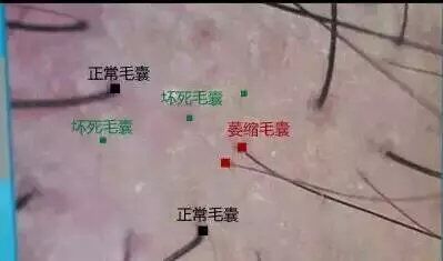 毛囊萎缩脱发是什么样子,毛囊萎缩是毛囊闭合吗