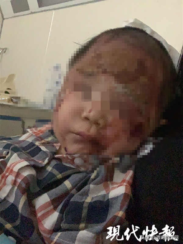 2岁男孩被开水烫伤手起泡几天好,烫伤了越来越肿正常情况多久消肿