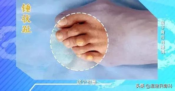 健康之路茧子,cctv10健康之路在线直播回看