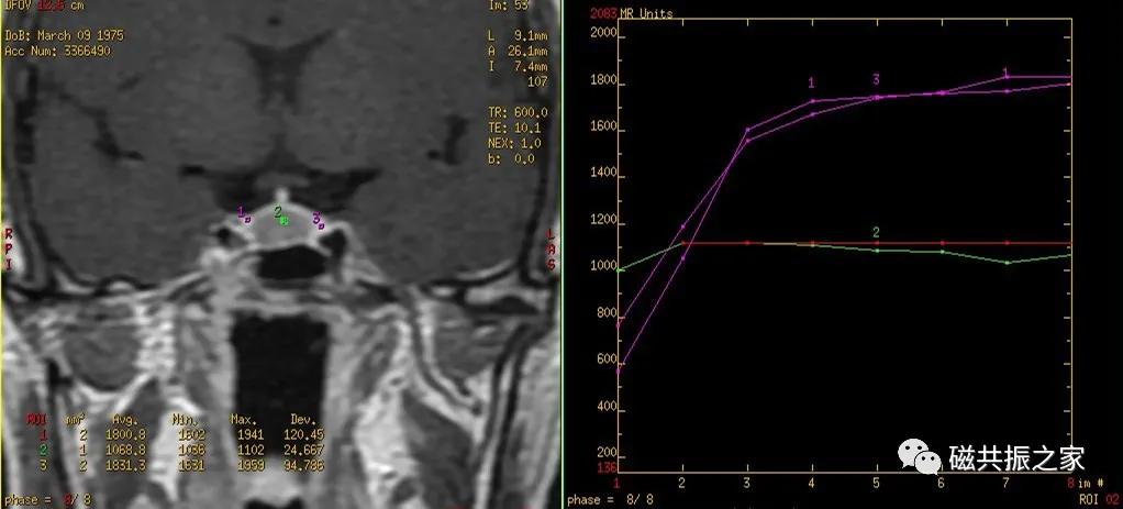 垂体mri扫描,垂体微腺瘤mri扫描