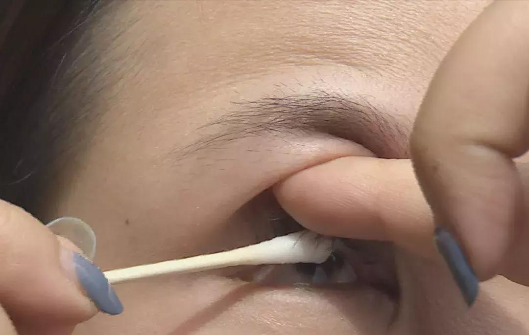 眼睛有异物感怎么处理,眼睛有异物感如何处理