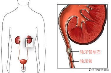 尿路小结石怎么治疗,为什么结石医生不建议做激光