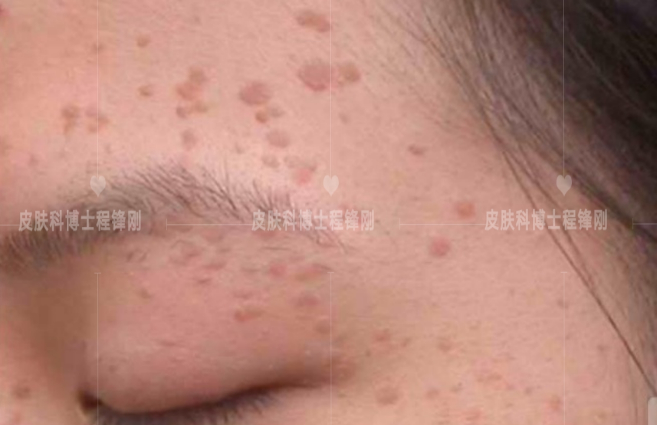 患有扁平疣要怎么根治,有扁平疣一定要及时去除吗