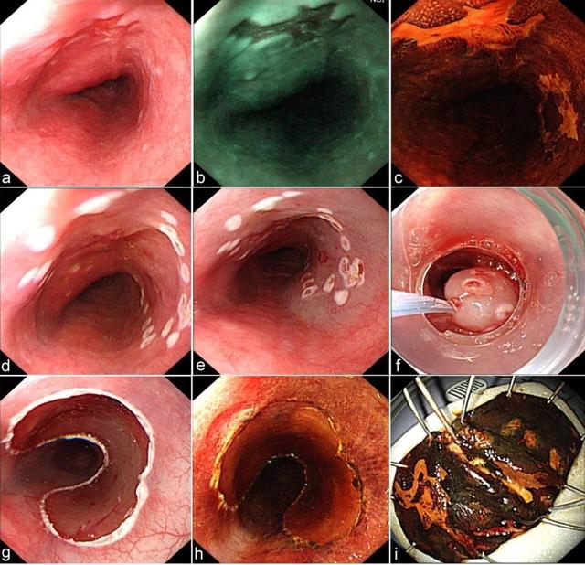 食管癌诊疗规范（2018年版）