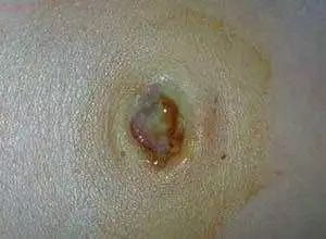 新生儿脐带未脱落发炎流脓,新生儿脐带红肿怎么处理