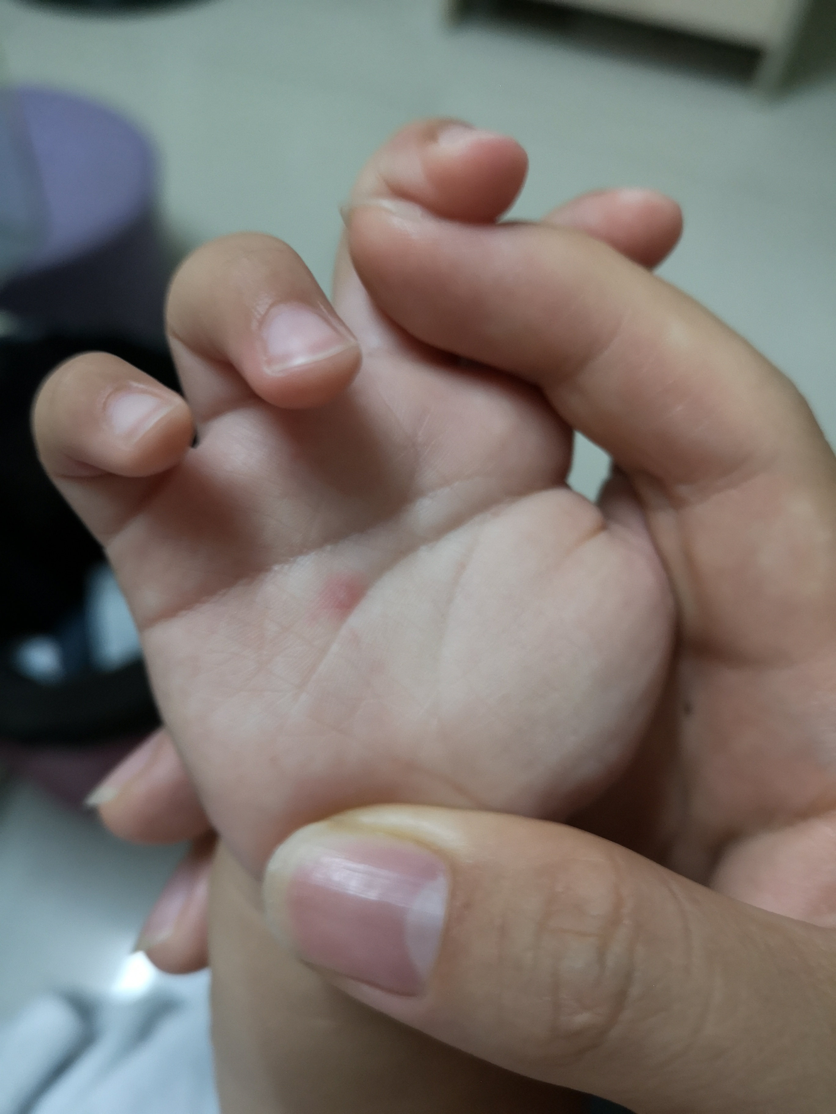 手足口疱疹性咽颊炎进入高发期,手足口高发期孩子有什么症状