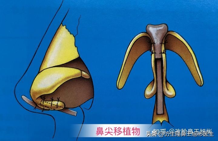 怎么做鼻尖可以做得更高,鼻尖塑形鼻头抬高