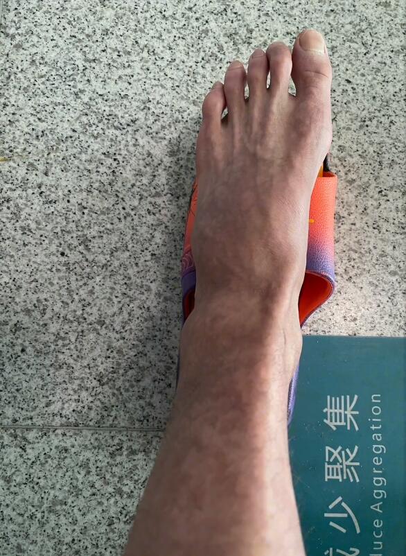 张国伟疲劳性骨折,张国伟跖骨骨折多久