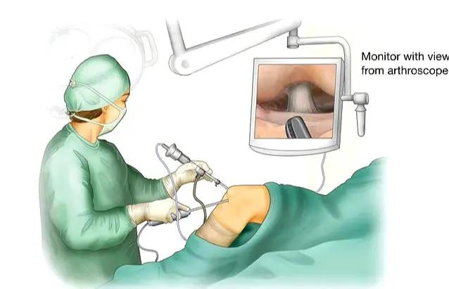 半月板撕裂诊断,半月板损伤撕裂要问医生哪些问题