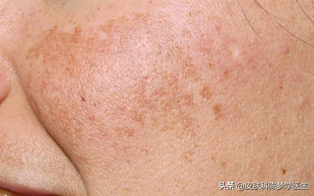 色斑的种类及治疗,色斑属于常见的什么皮肤问题