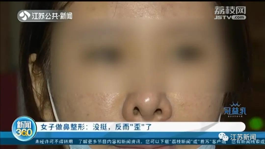 整容后鼻子越来越歪,整容鼻头歪斜