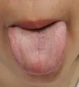 手上脚上起疙瘩又痒又痛咋回事,手上又肿又红又痒又痛还有流脓