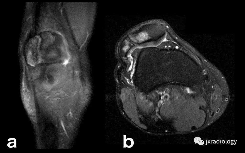 磁共振天天诊断骨髓水肿，但您知道原因吗？