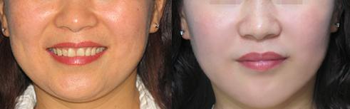 埋线面部提拉怎么样，做线雕能保持多久，不了解清楚还敢做？