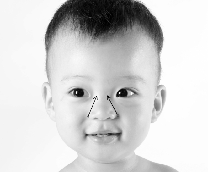 儿童扁桃体肥大最简单的偏方,小儿扁桃体肥大反复发炎怎么办