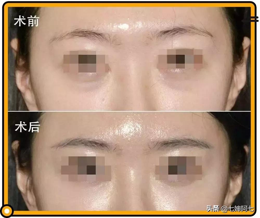 长久都无法消除的黑眼圈,顽固性的黑眼圈要怎么去