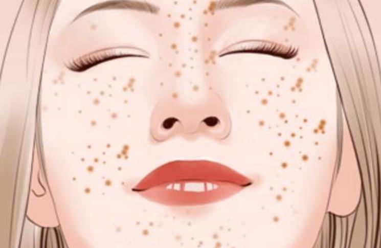 雀斑激光打了还会复发吗,雀斑一般用哪种激光最好