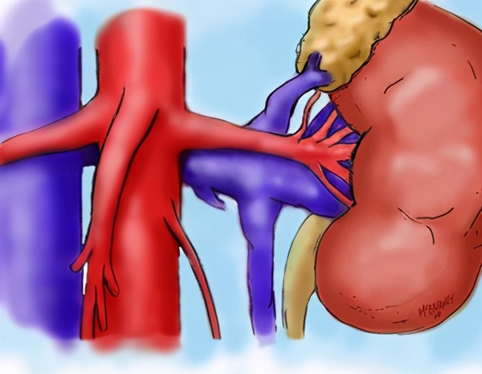 胡桃夹综合征血尿概率多少,胡桃夹综合征血尿是来自肾脏吗