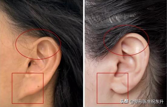 大拉皮手术失败,大拉皮手术后不流行