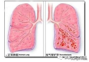 鱼腥草治支气管扩张,支气管扩张科普论文
