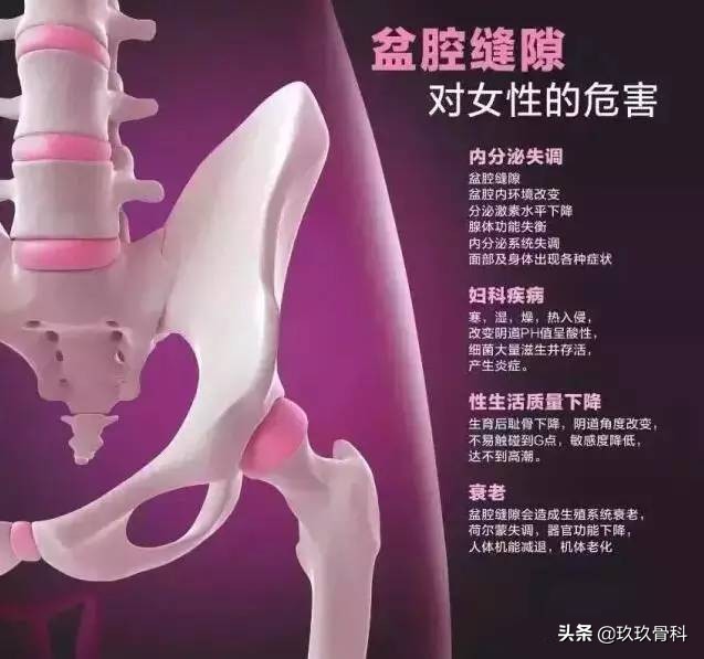 骨盆那些事儿：骨盆错位是女性疾病根源