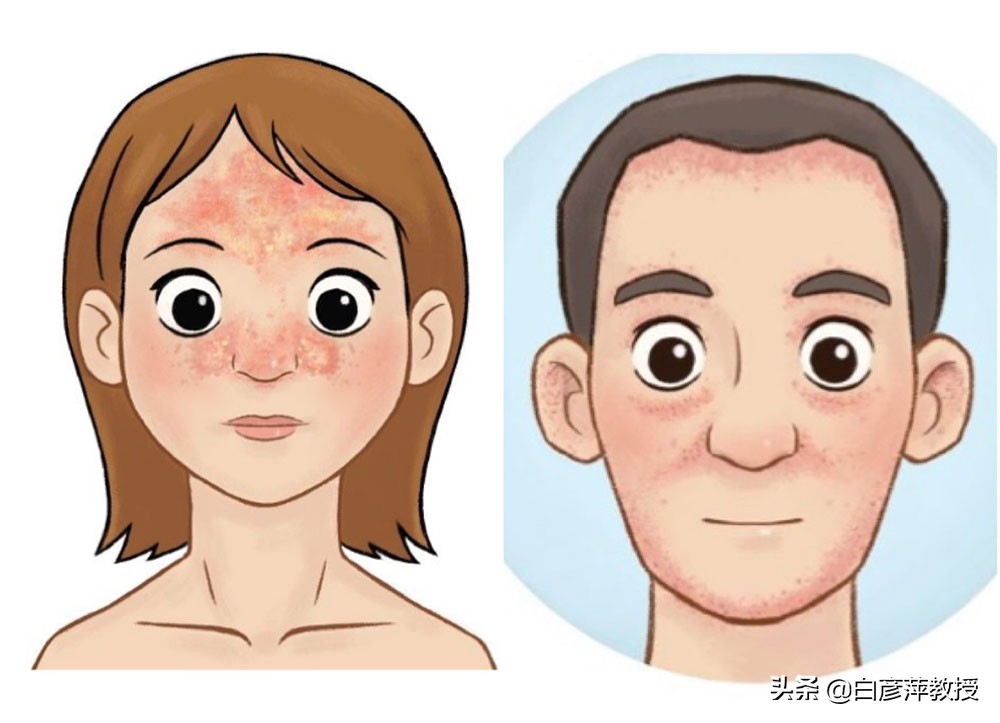 头发半天就油了怎么回事,脂溢性皮炎会出现丘疹吗